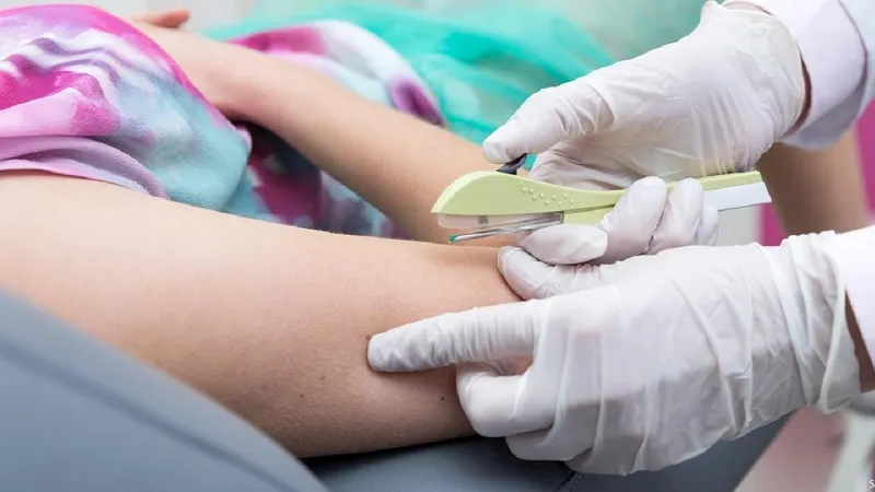 Hình ảnh minh họa phương pháp cấy que tránh thai, một biện pháp hiện đại
