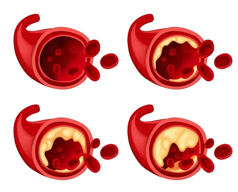 Mảng bám cholesterol trong lòng mạch máu gây cản trở lưu thông