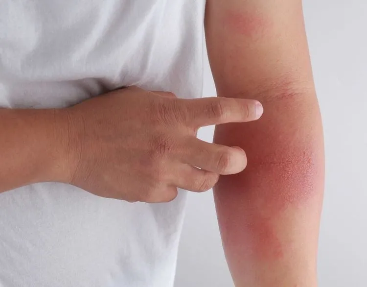 Một số bệnh nhân dùng Rosuvastatin có thể gặp tác dụng phụ trên da như phát ban, ngứa