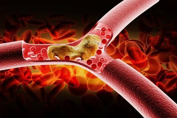 Hình ảnh minh họa triglyceride tích tụ trong cơ thể, gây hại khi chỉ số tăng cao.