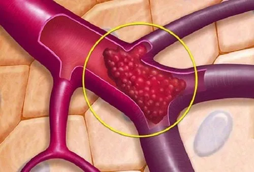 Sơ đồ minh họa sự hình thành cục máu đông (huyết khối) trong mạch máu