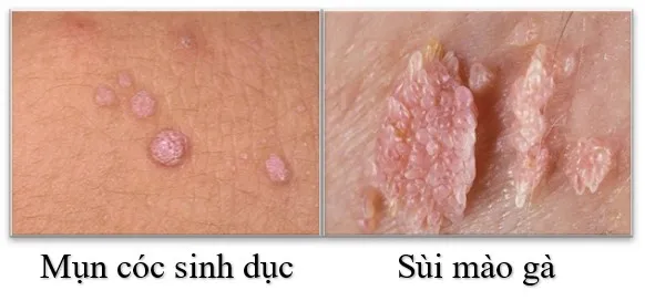 Hình ảnh minh họa sự khác nhau giữa sùi mào gà và mụn cóc sinh dục