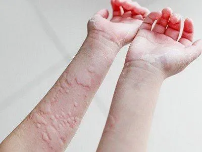 Tham khảo ý kiến bác sĩ khi xuất hiện mề đay, phát ban do dị ứng thuốc kháng sinh