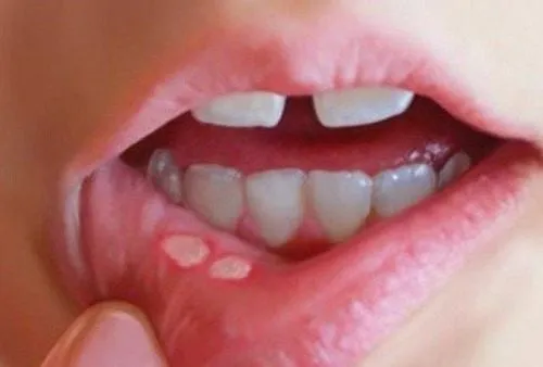 Hình ảnh minh họa: Thuốc Mucosta (Rebamipide) hỗ trợ điều trị viêm loét niêm mạc miệng trong bệnh Behcet