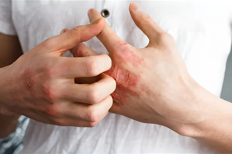 Hộp kem Eumovate Cream hỗ trợ điều trị nhiều bệnh da liễu.