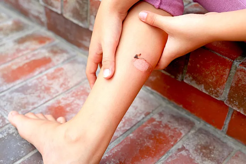 Lá xoài khô có thể dùng làm thuốc trị bỏng nhẹ