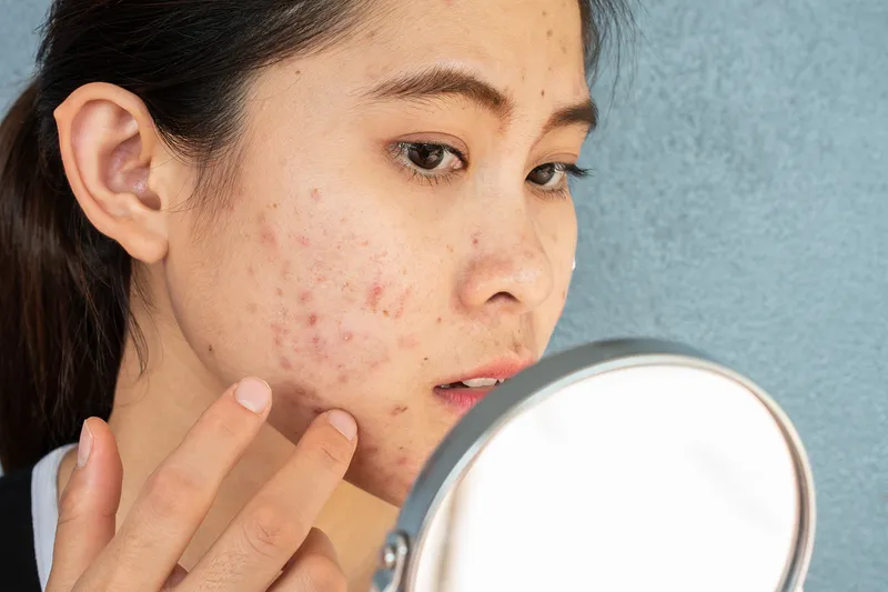 Điều trị mụn trứng cá, mụn đầu đen là một trong các tác dụng của tinh dầu tràm trà