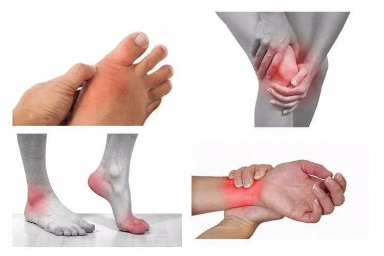 Hình ảnh minh họa: Viêm khớp