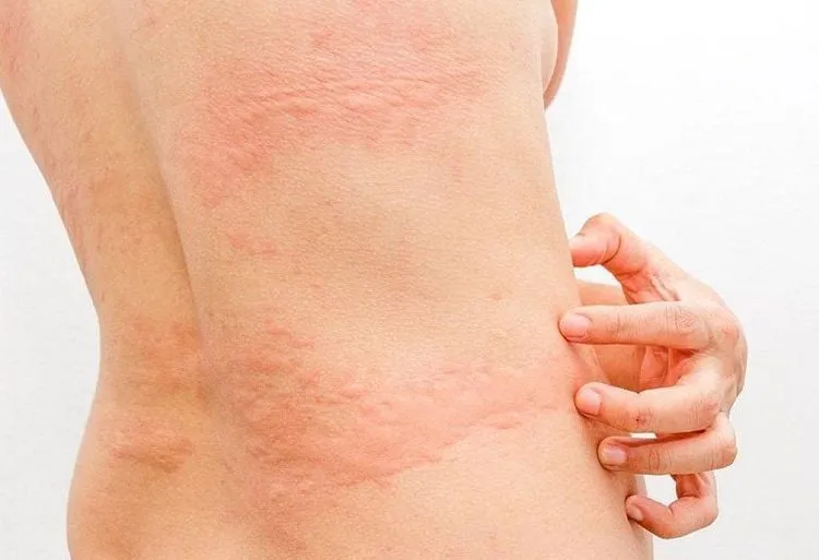 Hình ảnh minh họa tác dụng phụ nổi mề đay sau khi ngưng thuốc