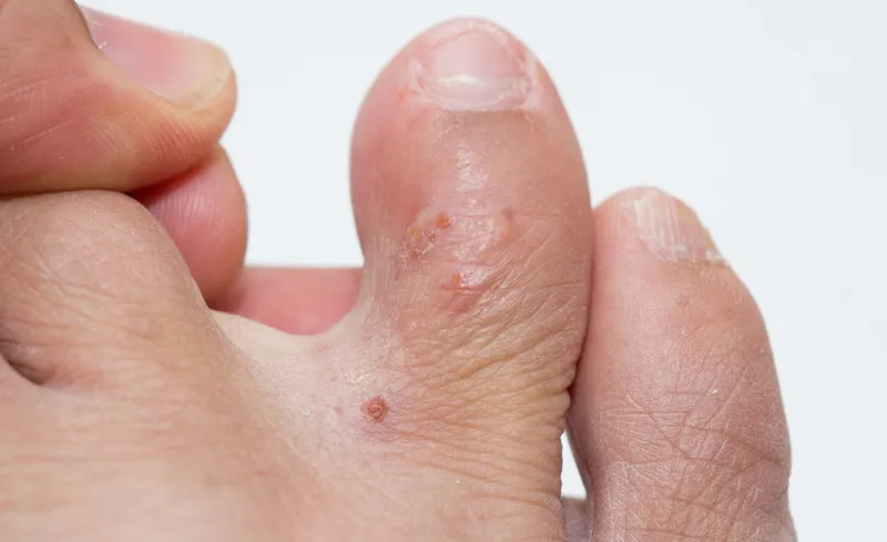 Mụn nước ở chân và ngứa có thể ảnh hưởng đến giấc ngủ