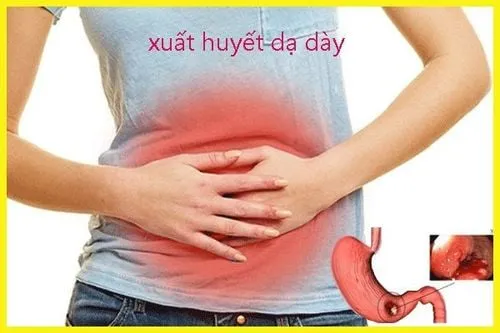 Hình ảnh minh họa: Xuất huyết dạ dày