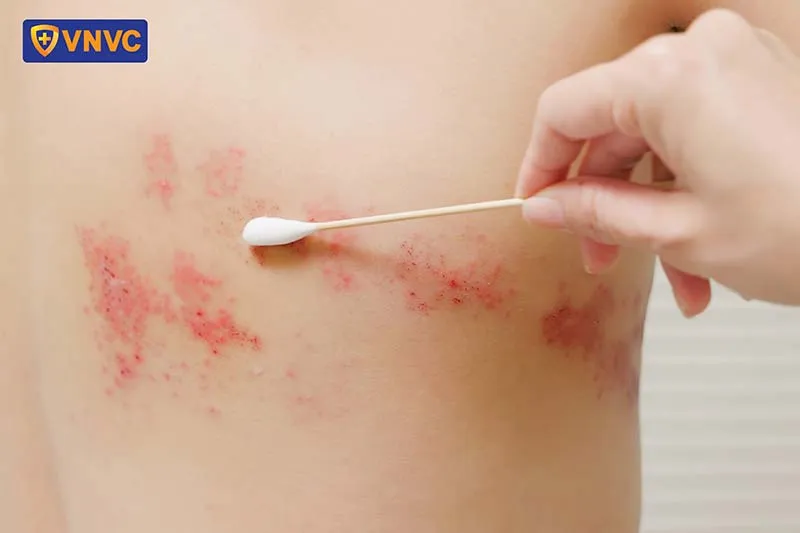 Nguyên tắc sử dụng thuốc bôi trị giời leo đúng cách