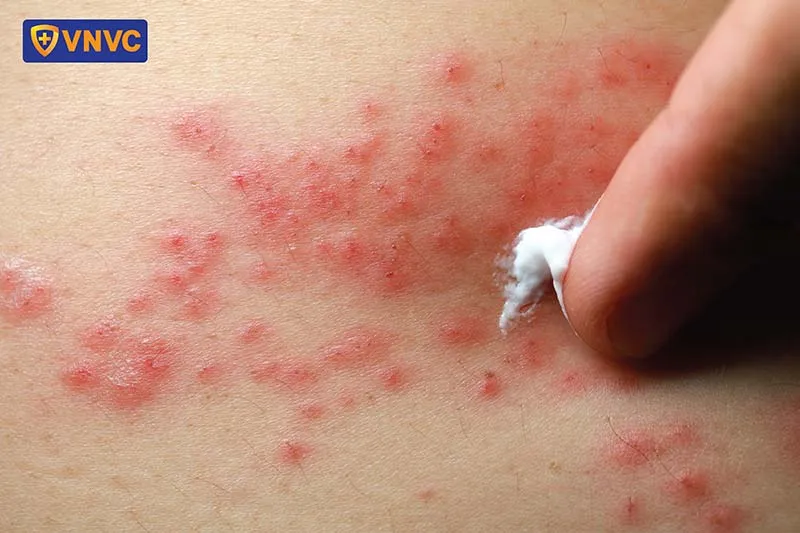 Các loại kem bôi và thuốc mỡ thường dùng trị giời leo